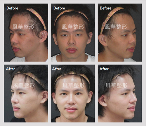 16岁男孩鼻中隔弯曲快开学了近几天能否手术