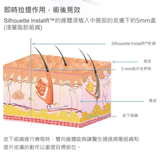 張立言醫師,鈴鐺線啦提,拉皮手術,拉皮,拉皮新技術,埋線拉提,台中拉皮推薦,整形,臉部下垂,嘴邊肉,法令紋