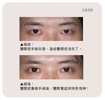 美容重修手術 搶救失敗的雙眼皮和隆鼻手術