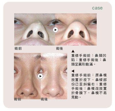 美容重修手術 搶救失敗的雙眼皮和隆鼻手術