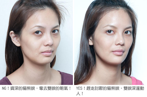 凝膠式玻尿酸注射─擋不住的貓熊眼，有救嗎？