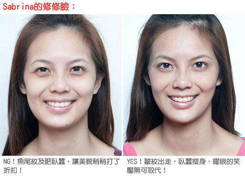 凝膠式玻尿酸注射─擋不住的貓熊眼，有救嗎？