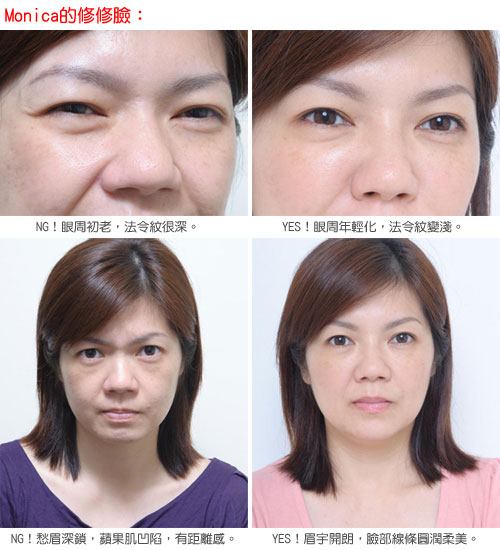 凝膠式玻尿酸注射─熟女素顔，為何不怒而威！？