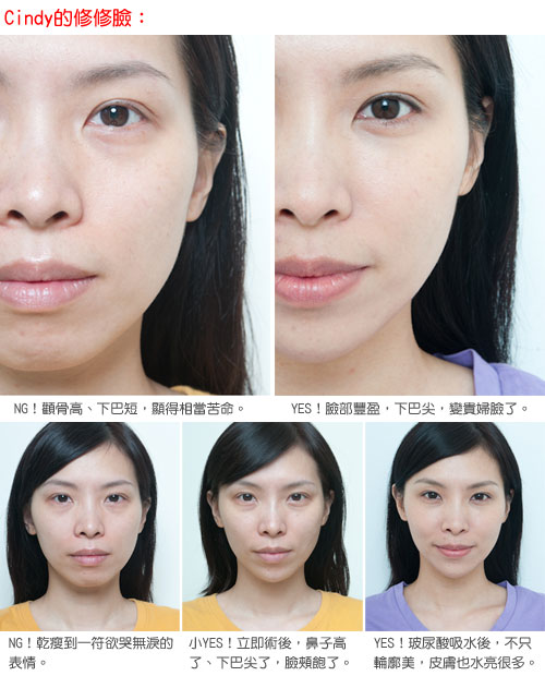凝膠式玻尿酸注射─現代苦情女，自我感覺良好，最重要！