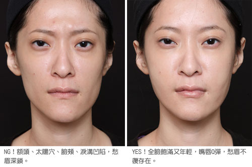botox775.jpg