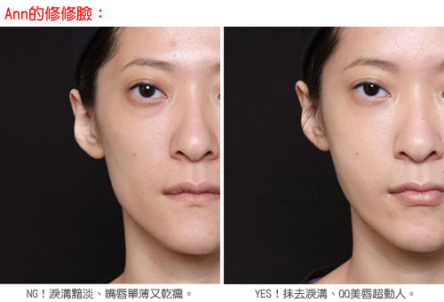 botox776.jpg