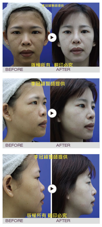 台中晶亮瓷、台中醫美推薦、台中微整形推薦、台中晶亮瓷山根、台中晶亮瓷下巴、台中晶亮瓷法令紋、台中晶亮瓷下巴、台中晶亮瓷微整形、台中晶亮瓷價錢、台中晶亮瓷費用、台中微整推薦、台中醫美、醫美診所推薦、整形外科推薦、台中整外推薦、李冠穎、吳肇權、台中采妍整形外科診所、台中推薦醫美采妍整形外科、晶亮瓷、法令紋、魚尾紋、醫美診所台中、晶亮瓷RDS價格、RDS費用、台中美容推薦、微整形格嘉、微整形菲仕美、群英整形、張立言整形、風格美學整形、周爾康、台中愛爾麗